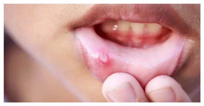 ulcers in the mouth