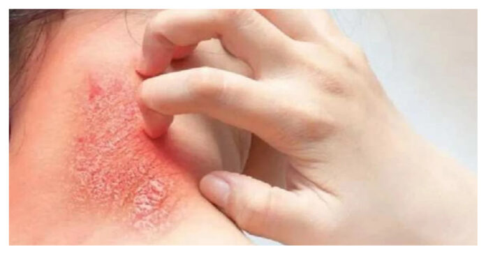 relief from itchy rash